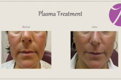 Skin Resurfacing and Rejuvenation Before After Case 07