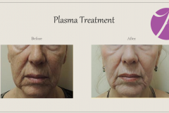 Skin Resurfacing and Rejuvenation Before After Case 06