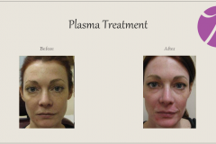 Skin Resurfacing and Rejuvenation Before After Case 05