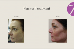 Skin Resurfacing and Rejuvenation Before After Case 04