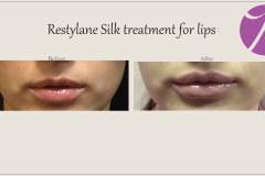 Lip Treatment Before After Case 01