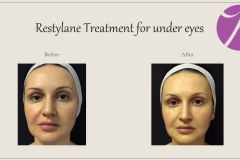 Eye Treatment Before After Case 03