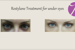 Eye Treatment Before After Case 02