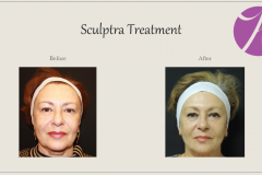 Sculptra for Rejuvenation Before After Case 12