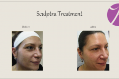 Sculptra for Rejuvenation Before After Case 11