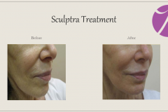 Sculptra for Rejuvenation Before After Case 10