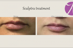 Sculptra for Rejuvenation Before After Case 09