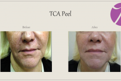 Chemical Peels and Microdermabrasion Before After Case 08