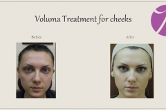 Cheeks, Nasolabial folds and Chin Treatment Before After Case 02