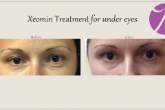 Eye Treatment Before After Case 01