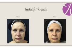 Facial Threads Before After Case 01