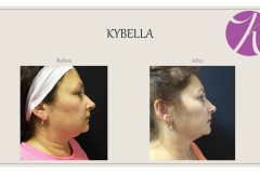 KYBELLA Fat Removal Before After Case 01