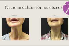 Neuromodulators Before After Case 01