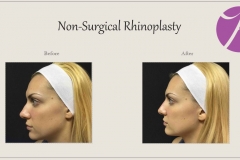 Non-Surgical Rhinoplasty Before After Case 01
