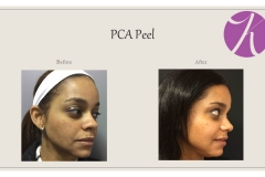 Chemical Peels and Microdermabrasion Before After Case 05