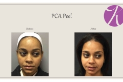 Chemical Peels and Microdermabrasion Before After Case 04