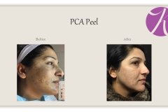 Chemical Peels and Microdermabrasion Before After Case 06