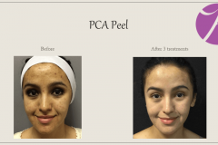 Chemical Peels and Microdermabrasion Before After Case 02