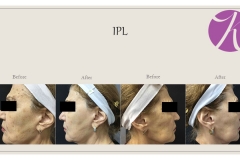 Pigmentation Treatment Before After Case 01