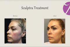 Sculptra for Rejuvenation Before After Case 06