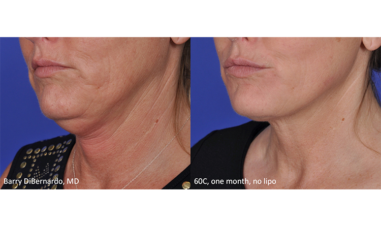 01 Month Lipo 01 Month Lipo