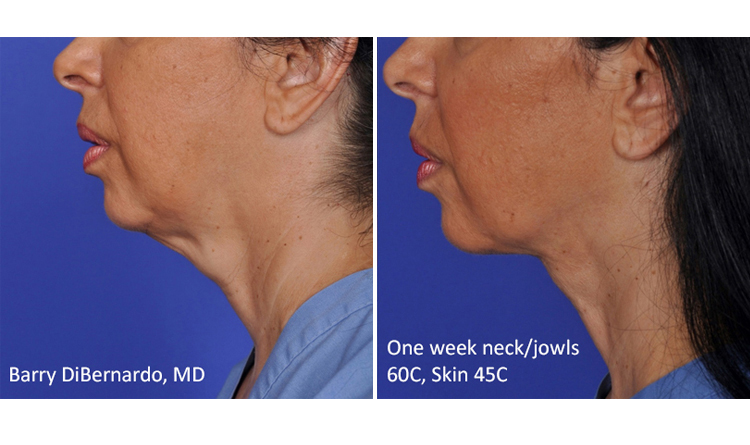 1 Week Neck Jowls 1 Week Neck Jowls