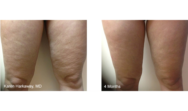 THERMITIGHT Treatment, 4-Months on Legs THERMITIGHT Treatment, 4-Months on Legs