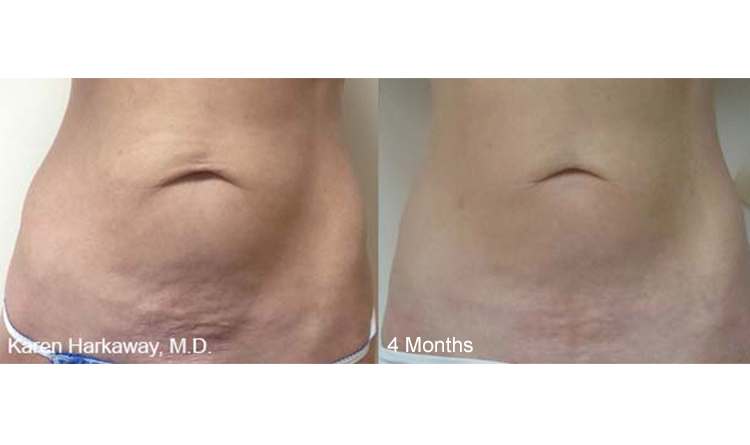 THERMITIGHT Treatment, 4 Months on Stomach THERMITIGHT Treatment, 4 Months on Stomach