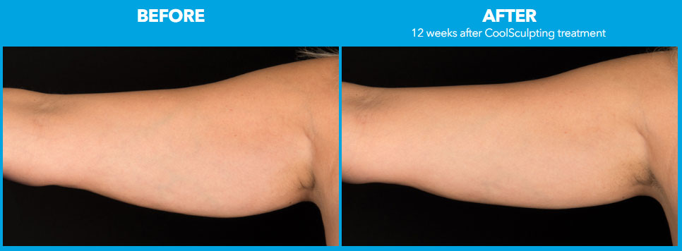 Batwings Treatment Before After Batwings Treatment Before After