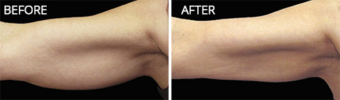 Batwings Before after 01 Batwings Before after 01