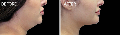 Coolsculpting Before after01 Coolsculpting Before after01