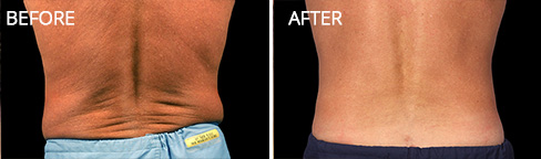 Coolsculpting Before after 02 Coolsculpting Before after 02