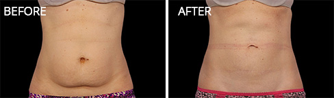 Coolsculpting Before after 03 Coolsculpting Before after 03