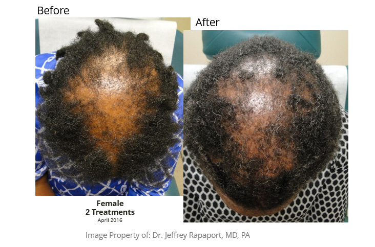 Hair Restoration Befoer After 02