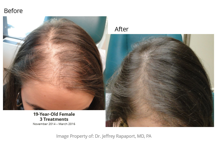 Hair Restoration Before After