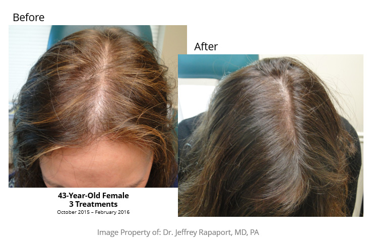 Hair Restoration Before After 04