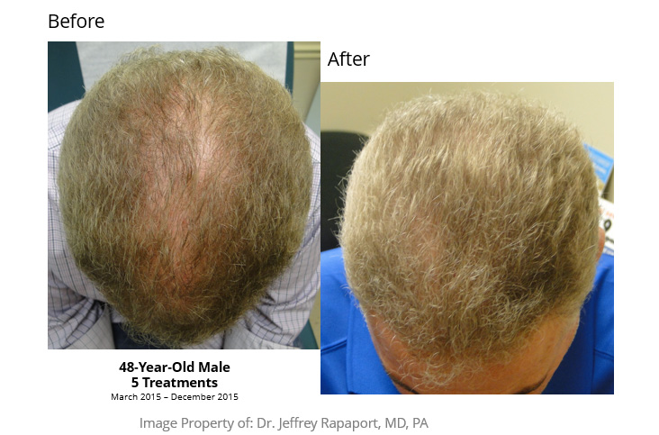 Hair Restoration Before After 03