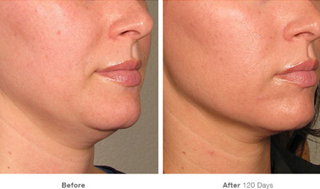 Utherapy Underchin Results