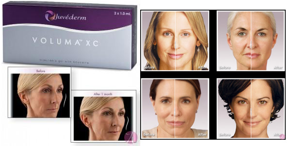Juvederm Voluma 