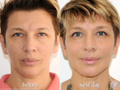 Y lift Before After case 06 Y lift Before After case 06