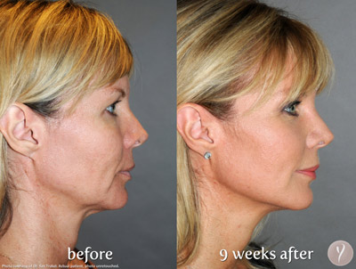 Y lift Before After case 04 Y lift Before After case 04