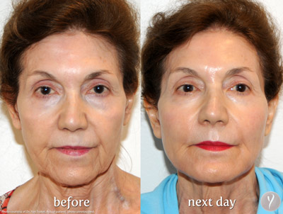 Y lift Before After case 06 Y lift Before After case 06