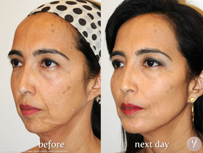 Y lift, Before after Case 02 Y lift, Before after Case 02
