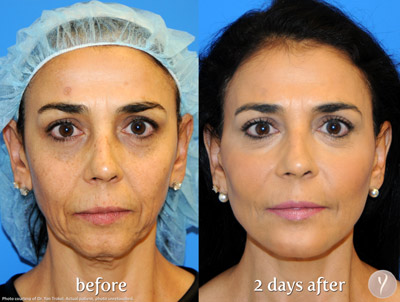 Y lift. Before After Y lift. Before After