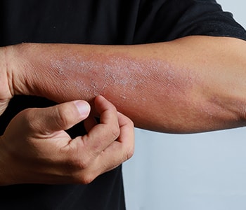 What to Expect with Eczema Light Therapy in Brooklyn, NY