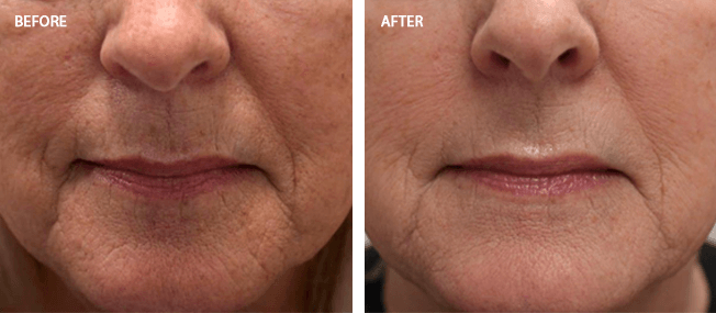 before and after actual patient of LaseMD