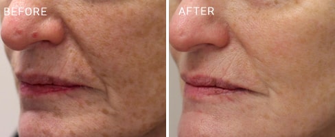 LaserMD Skin Case 4