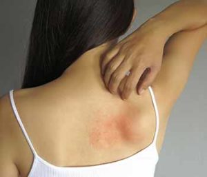 Psoriasis is a skin disorder that can be a chronic problem for men and women.