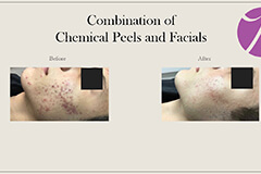 Acne 1 Thumb