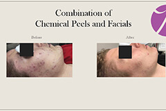 Acne 2 Thumb